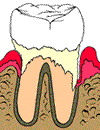 moderate perio